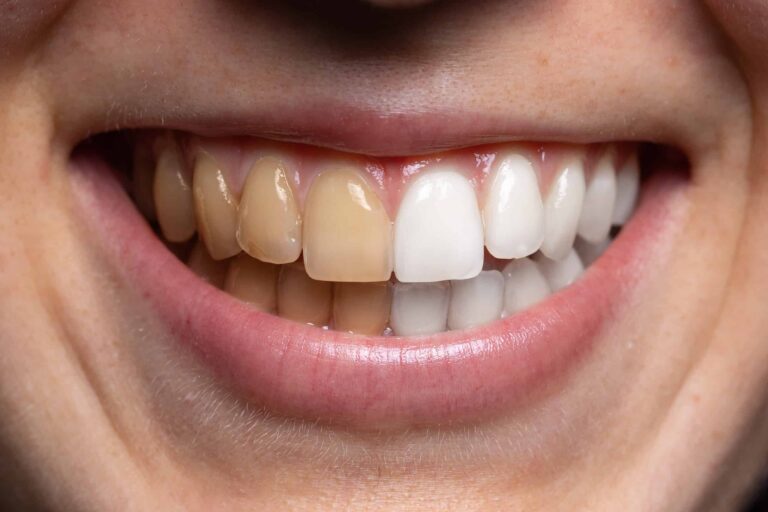 How To Whiten Teeth At Home?