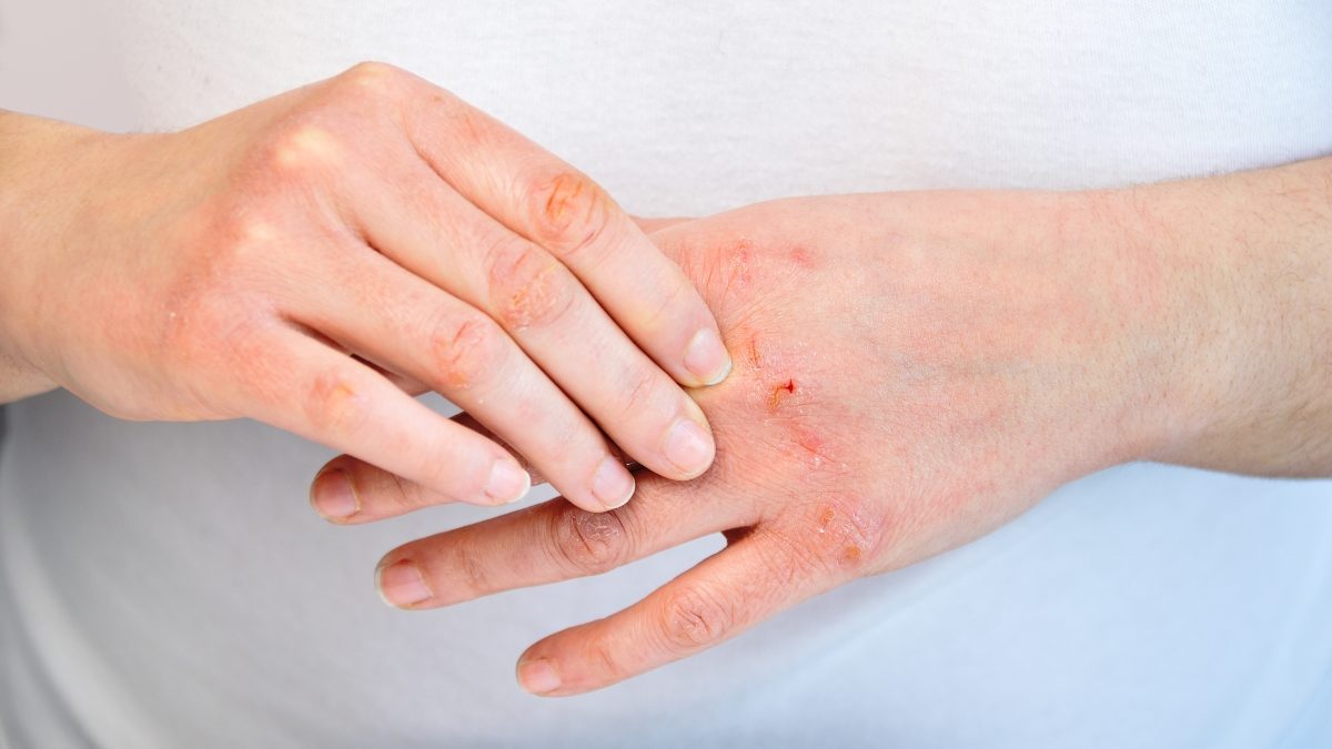 Worried About Dermatitis? These Tips Can Help You Out