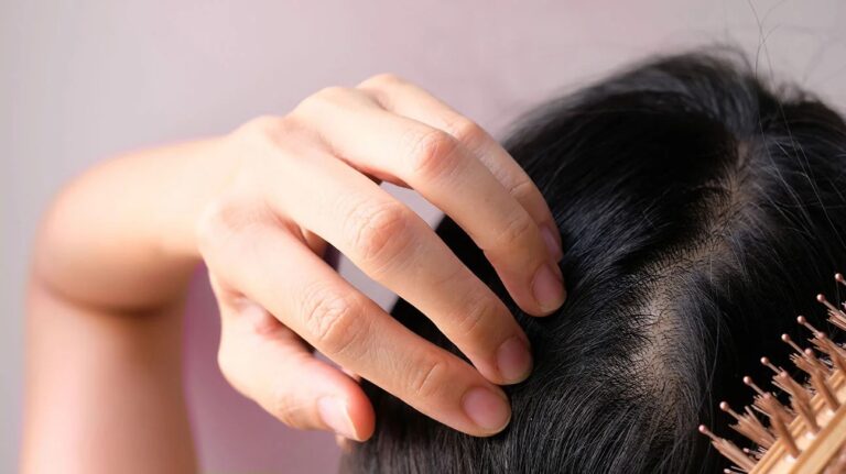 Hair Loss in Women: All You Need to Know to Keep Your Precious Locks (2023)